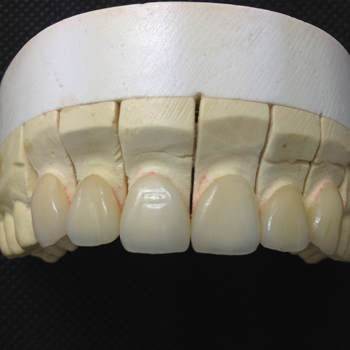 Key points about dental veneers